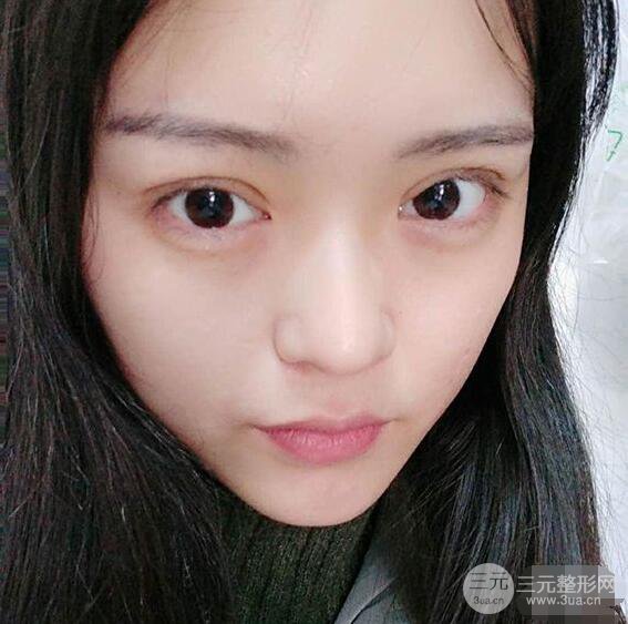浙一医院美容科吴慧玲单眼皮割双眼皮前后对比图|单眼皮的秘密武器
