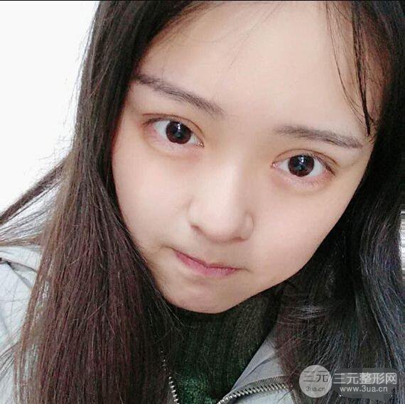 浙一医院美容科吴慧玲单眼皮割双眼皮前后对比图|单眼皮的秘密武器