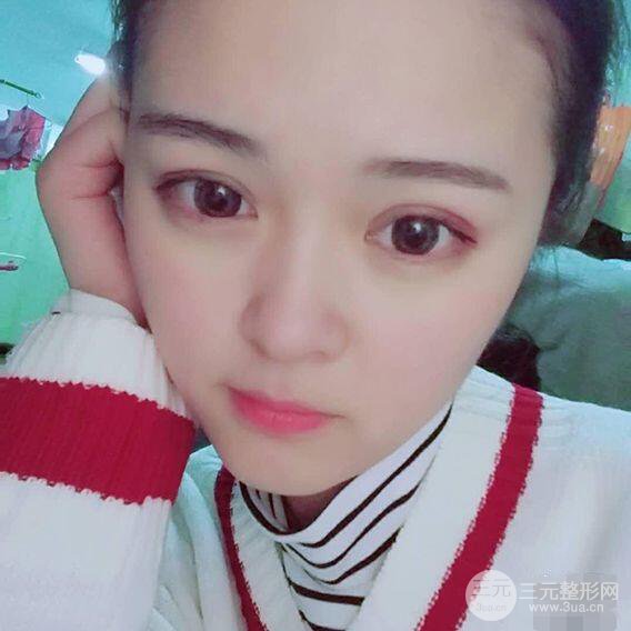 浙一医院美容科吴慧玲单眼皮割双眼皮前后对比图|单眼皮的秘密武器