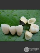 镍铬合金烤瓷牙怎么样？烤瓷牙哪些材质的好？