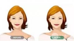 注射瘦脸生物除皱多少钱?