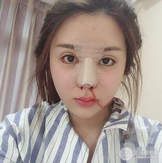 昆明吴氏嘉美李明硅胶隆鼻前后对比图恢复心情小札