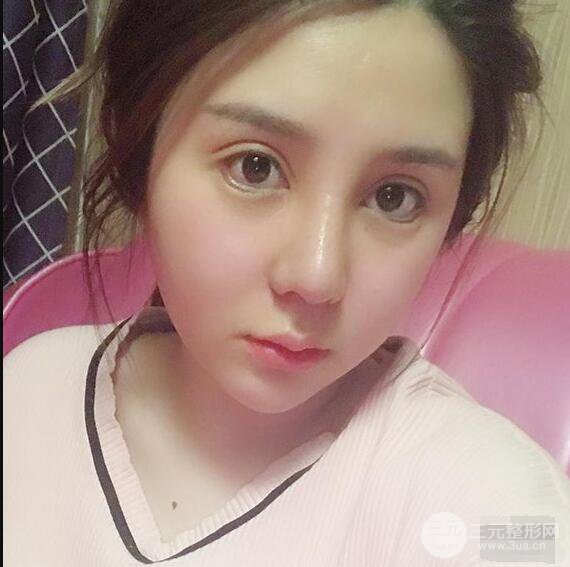 昆明吴氏嘉美李明硅胶隆鼻前后对比图恢复心情小札