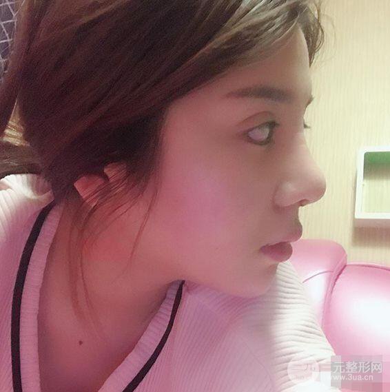昆明吴氏嘉美李明硅胶隆鼻前后对比图恢复心情小札