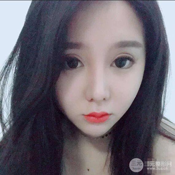 昆明吴氏嘉美李明硅胶隆鼻前后对比图恢复心情小札