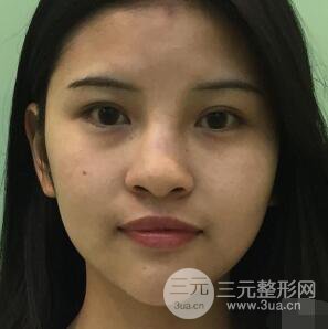 成都华西医院整形美容科卿勇隆鼻整形前后对比图恢复心情小札
