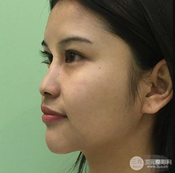 成都华西医院整形美容科卿勇隆鼻整形前后对比图恢复心情小札