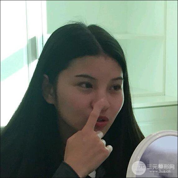成都华西医院整形美容科卿勇隆鼻整形前后对比图恢复心情小札