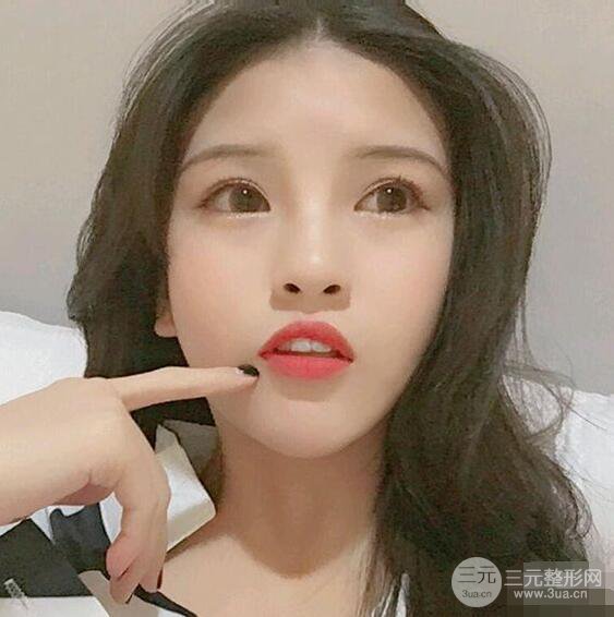 成都华西医院整形美容科卿勇隆鼻整形前后对比图恢复心情小札