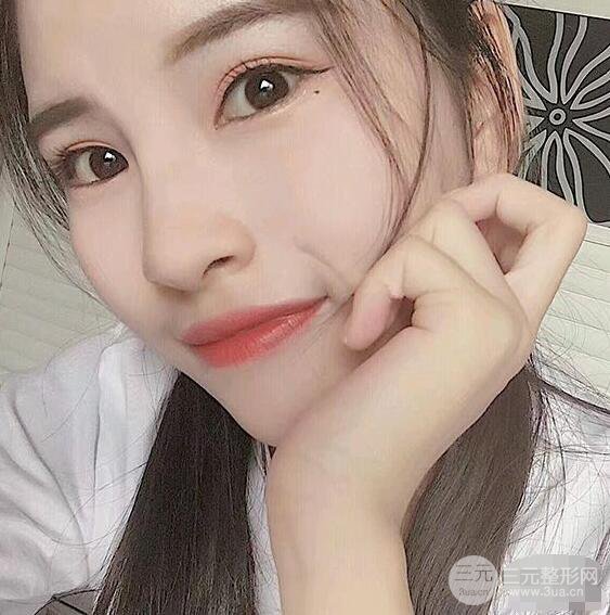 成都华西医院整形美容科卿勇隆鼻整形前后对比图恢复心情小札