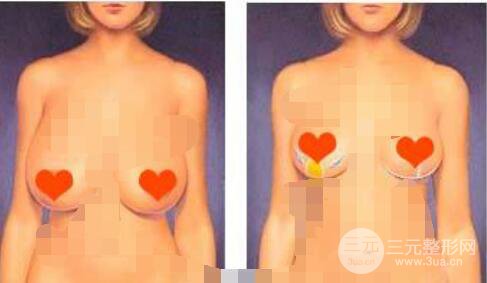 乳房下垂矫正,多少钱