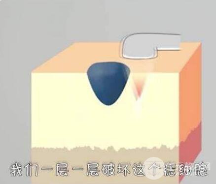 武汉医院点痦子多少钱?激光点痦子贵吗?