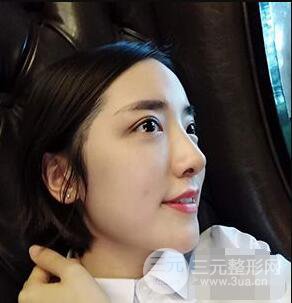 杭州格莱美张树功假体隆鼻前后对比图|内附恢复心情变化哦