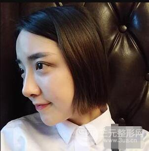 杭州格莱美张树功假体隆鼻前后对比图|内附恢复心情变化哦