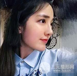 杭州格莱美张树功假体隆鼻前后对比图|内附恢复心情变化哦