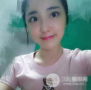 杭州格莱美张树功假体隆鼻前后对比图|内附恢复心情变化哦