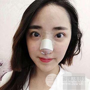 杭州格莱美张树功假体隆鼻前后对比图|内附恢复心情变化哦