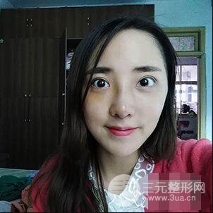 杭州格莱美张树功假体隆鼻前后对比图|内附恢复心情变化哦