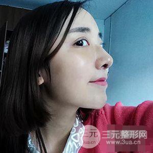 杭州格莱美张树功假体隆鼻前后对比图|内附恢复心情变化哦