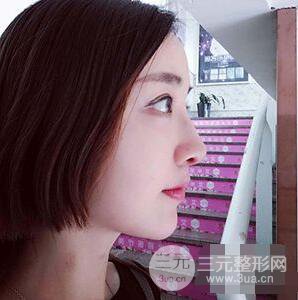 杭州格莱美张树功假体隆鼻前后对比图|内附恢复心情变化哦