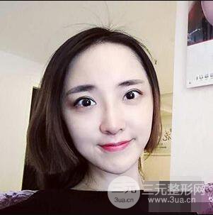 杭州格莱美张树功假体隆鼻前后对比图|内附恢复心情变化哦