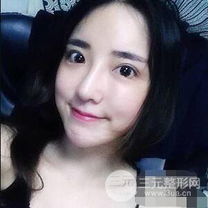 杭州格莱美张树功假体隆鼻前后对比图|内附恢复心情变化哦