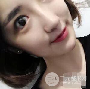 杭州格莱美张树功假体隆鼻前后对比图|内附恢复心情变化哦