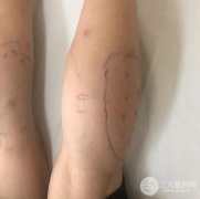 注射瘦腿有副作用吗？注射瘦腿多少钱一针？
