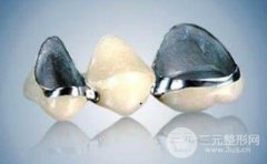 镍铬烤瓷牙的危害有哪些呢