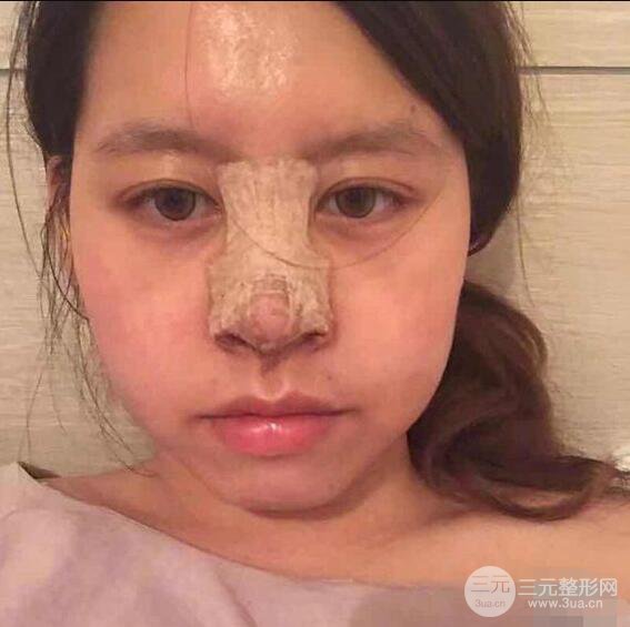 重庆华美何春涛硅胶隆鼻前后对比图 内附恢复心情小札