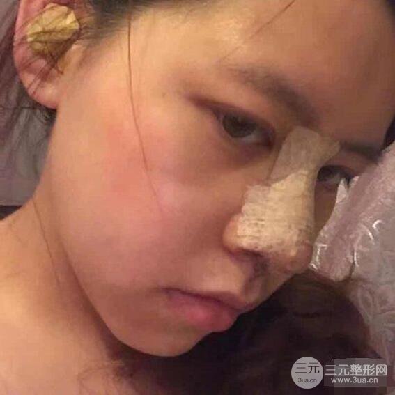 重庆华美何春涛硅胶隆鼻前后对比图 内附恢复心情小札