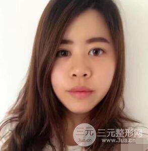 重庆华美何春涛硅胶隆鼻前后对比图 内附恢复心情小札