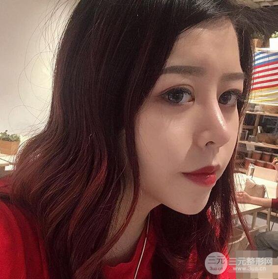 重庆华美何春涛硅胶隆鼻前后对比图 内附恢复心情小札