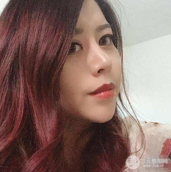 重庆华美何春涛硅胶隆鼻前后对比图 内附恢复心情小札