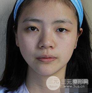 贵阳美贝尔黄在弘全切双眼皮前后对比图|**解决大小眼