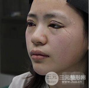 贵阳美贝尔黄在弘全切双眼皮前后对比图|**解决大小眼