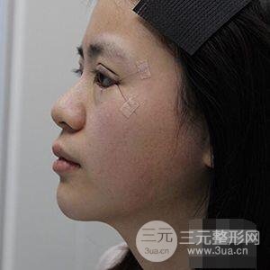 贵阳美贝尔黄在弘全切双眼皮前后对比图|**解决大小眼