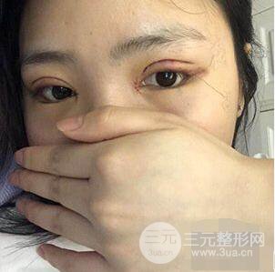 贵阳美贝尔黄在弘全切双眼皮前后对比图|**解决大小眼