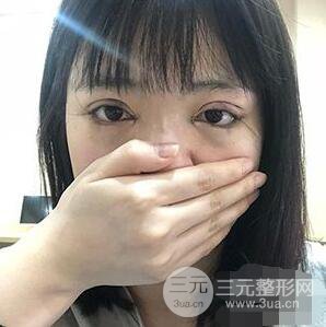 贵阳美贝尔黄在弘全切双眼皮前后对比图|**解决大小眼