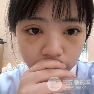 贵阳美贝尔黄在弘全切双眼皮前后对比图|**解决大小眼