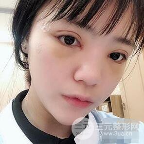贵阳美贝尔黄在弘全切双眼皮前后对比图|**解决大小眼