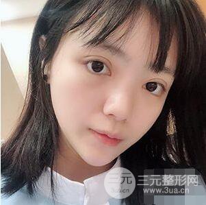 贵阳美贝尔黄在弘全切双眼皮前后对比图|**解决大小眼