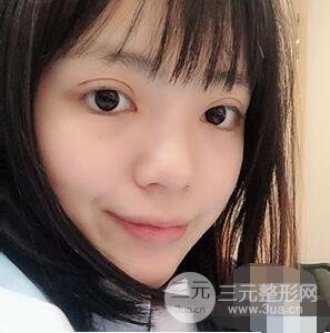 贵阳美贝尔黄在弘全切双眼皮前后对比图|**解决大小眼