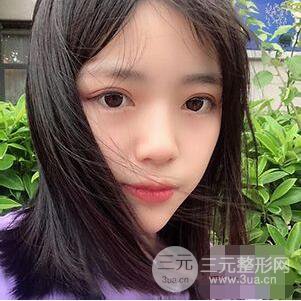 贵阳美贝尔黄在弘全切双眼皮前后对比图|**解决大小眼