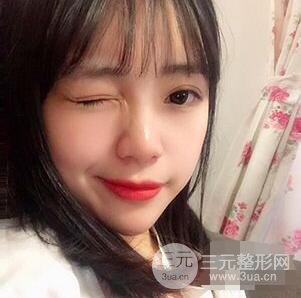 贵阳美贝尔黄在弘全切双眼皮前后对比图|**解决大小眼