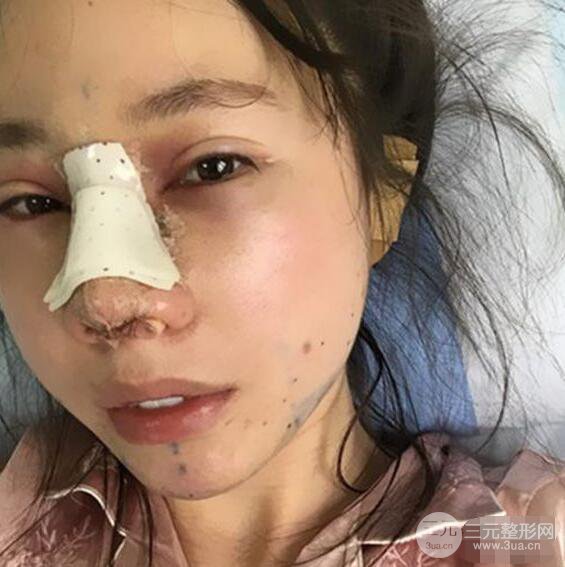 北京联合丽格吴焱秋耳软骨隆鼻前后对比图|塌鼻子的救星