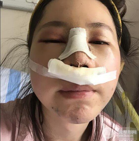 北京联合丽格吴焱秋耳软骨隆鼻前后对比图|塌鼻子的救星