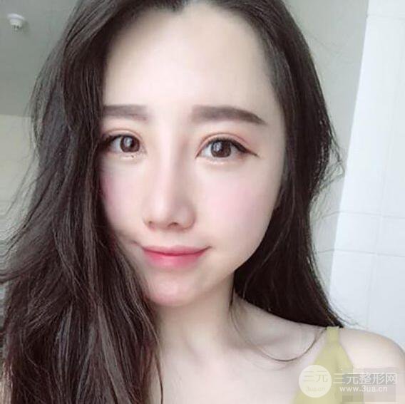 北京联合丽格吴焱秋耳软骨隆鼻前后对比图|塌鼻子的救星