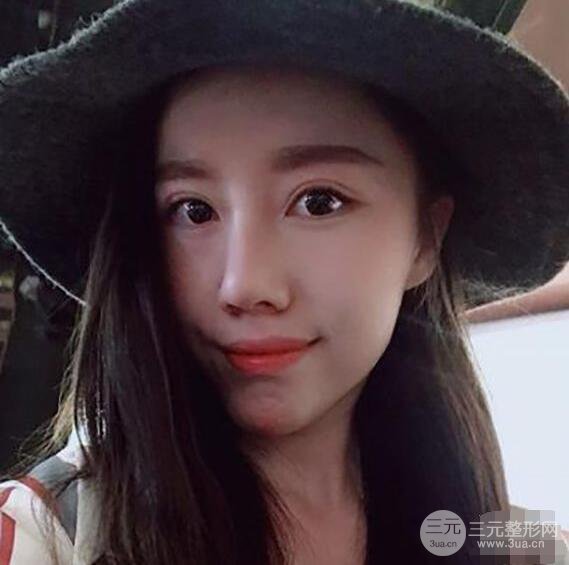 北京联合丽格吴焱秋耳软骨隆鼻前后对比图|塌鼻子的救星