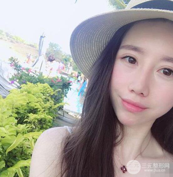 北京联合丽格吴焱秋耳软骨隆鼻前后对比图|塌鼻子的救星